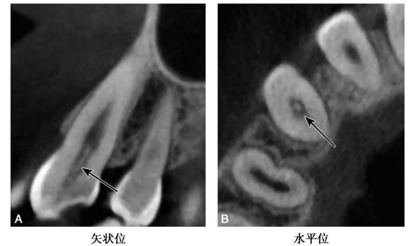 详述牙髓钙化的CBCT表现
