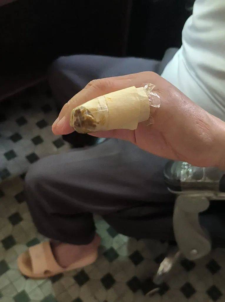 “一阵钻心的痛”，佛山九旬阿伯午休时大拇指被蜈蚣咬伤：不是第一次了